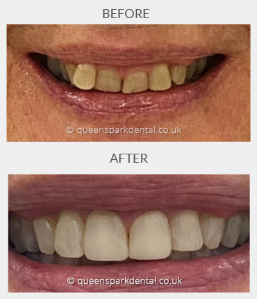 Invisalign Case1