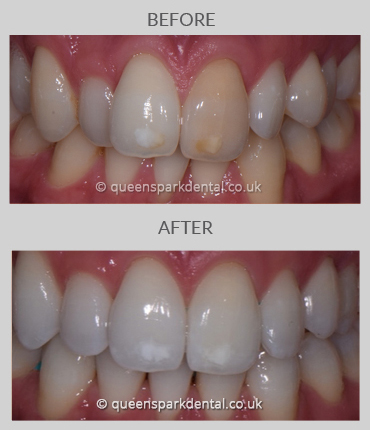 Invisalign Case3