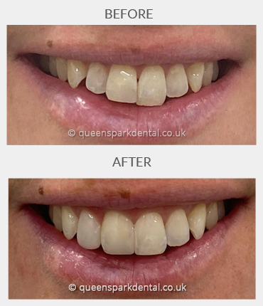 Invisalign Case4