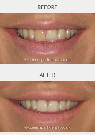 Porcelain Veneers