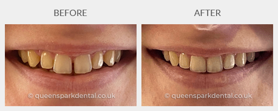 Gemma, 25, Female (Invisalign)