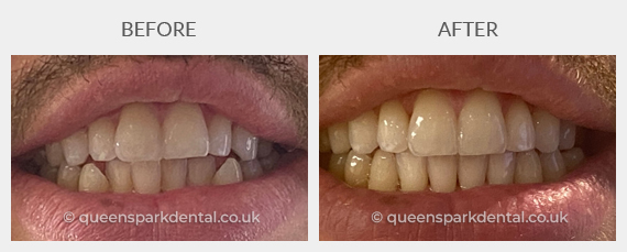 Oliver, 32, Male (Invisalign)
