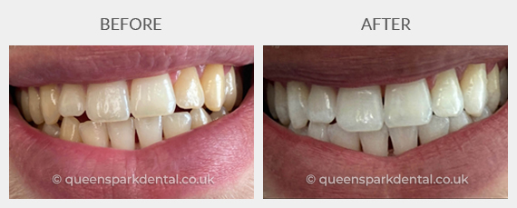 Reuben, 35, Male (Enlighten Teeth Whitening)